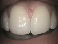 Discolored Tooth 