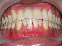 Discolored Tooth 