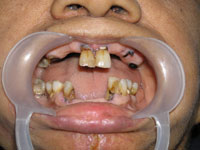 Complete Denture