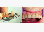 Removable Partial Dentures