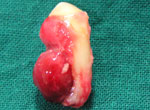 cyst