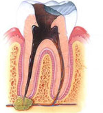 Root Canal Therapy