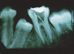 Root Canal Therapy