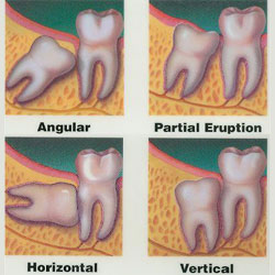 wisdom teeth removed