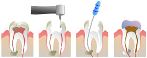 Root Canal Therapy