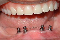 Single Tooth Implant