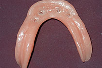 Single Tooth Implant