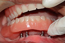 Single Tooth Implant