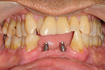 Single Tooth Implant