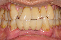 Single Tooth Implant