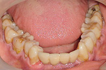 Single Tooth Implant