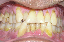 Single Tooth Implant