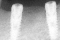 Single Tooth Implant