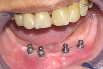 Single Tooth Implant