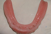 Single Tooth Implant