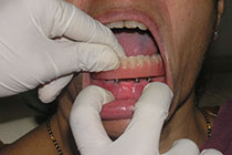 Single Tooth Implant