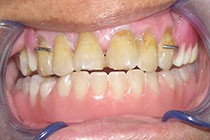 Single Tooth Implant