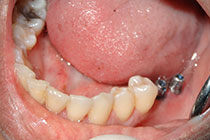 Single Tooth Implant