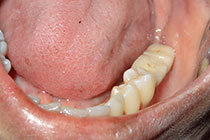 Single Tooth Implant