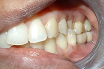 Single Tooth Implant