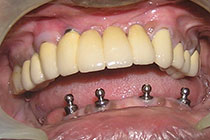 Single Tooth Implant