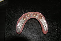 Single Tooth Implant