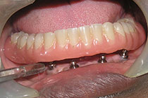 Single Tooth Implant