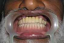 Single Tooth Implant