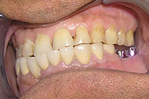 Single Tooth Implant