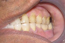 Single Tooth Implant