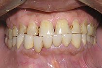 Single Tooth Implant