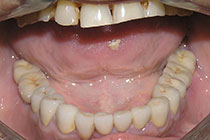 Single Tooth Implant