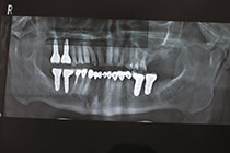 Single Tooth Implant