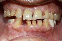 Single Tooth Implant