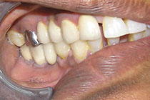 Single Tooth Implant