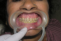 Single Tooth Implant