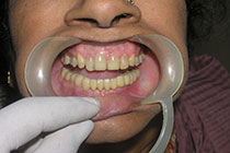 Single Tooth Implant