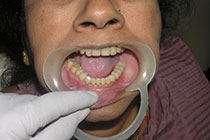 Single Tooth Implant