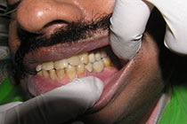 Single Tooth Implant