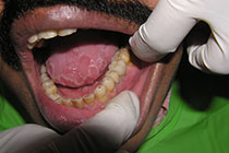 Single Tooth Implant