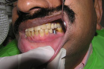 Single Tooth Implant