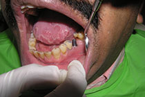 Single Tooth Implant