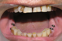 Single Tooth Implant