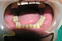 Single Tooth Implant