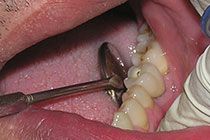 Single Tooth Implant