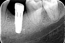 Single Tooth Implant