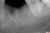 Single Tooth Implant