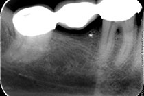 Single Tooth Implant