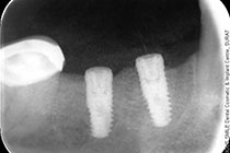 Single Tooth Implant