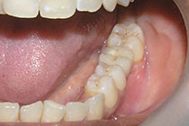 Single Tooth Implant